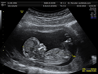 An ultrasound of a baby at 12 weeks and six days.  Credit: Wolfgang Moroder via Wikipedia.